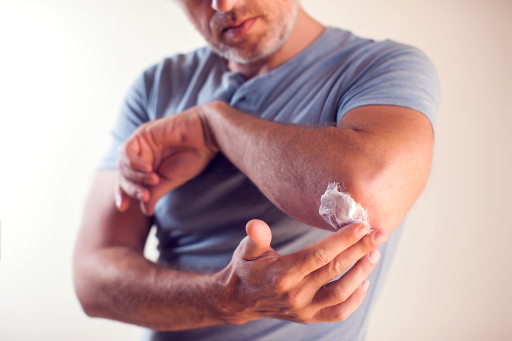 Man,Applies,Cream,On,Dry,Elbow.people,,Healthcare,And,Medicine,Concept